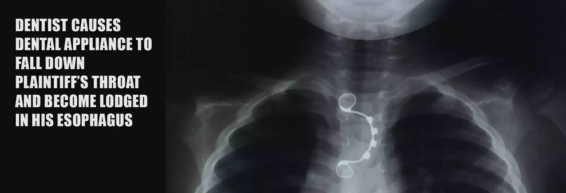 Dentist causes dental appliance to fall down plaintiff’s throat and become lodged in his esophagus