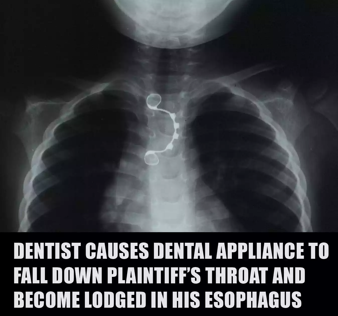 Dentist causes dental appliance to fall down plaintiff’s throat and become lodged in his esophagus